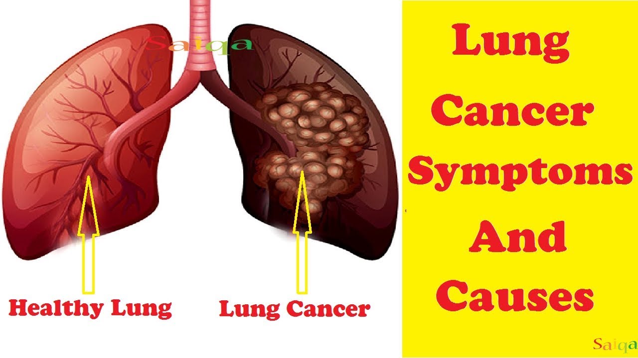 lung cancer causes
