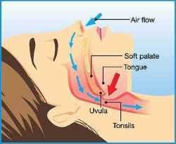 snoring-treatment-in-dubai